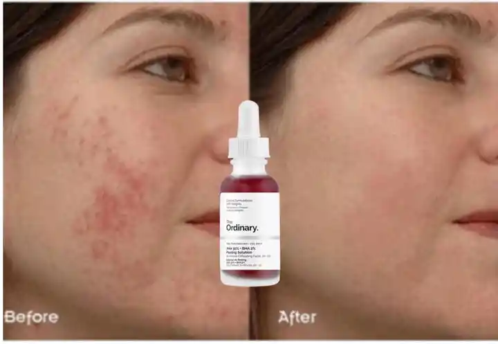 THE ORDINARY Peeling Solution Aha 30% + Bha 2% De