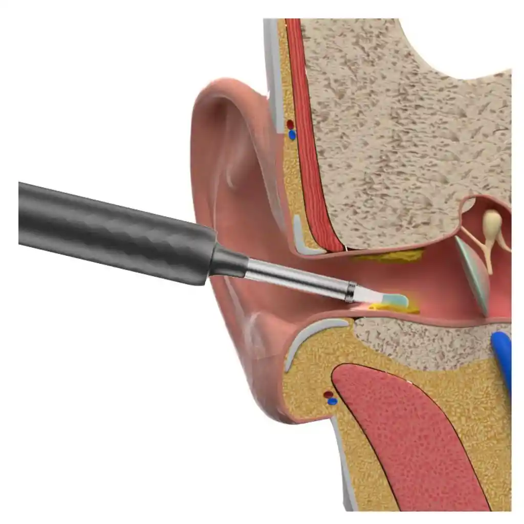 Limpiador De Oidos Con Camara Recargable Usb
