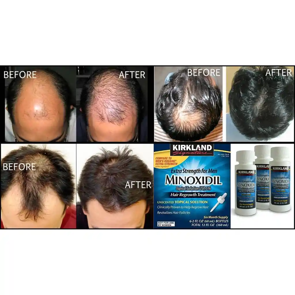 Kirkland Minoxidil 5% Extra Strength Caja X6