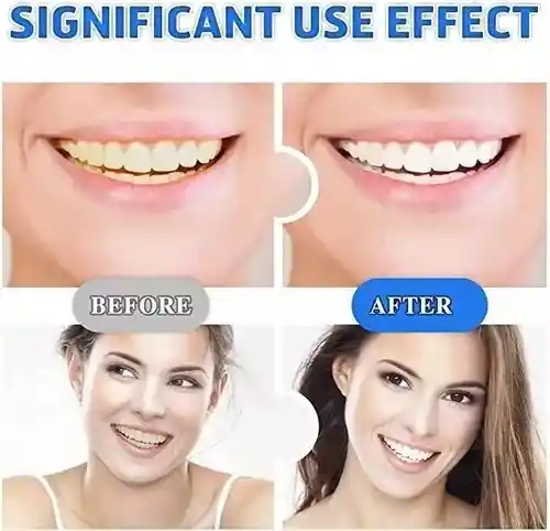 Tira De Gel Blanqueador Dental 5d White X7 Pares Banditas