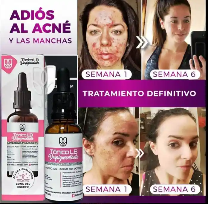 Despigmetante Tónico Quita Manchas Acné Pecas Aclarante.