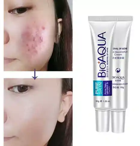 Crema Removedora Antiacne