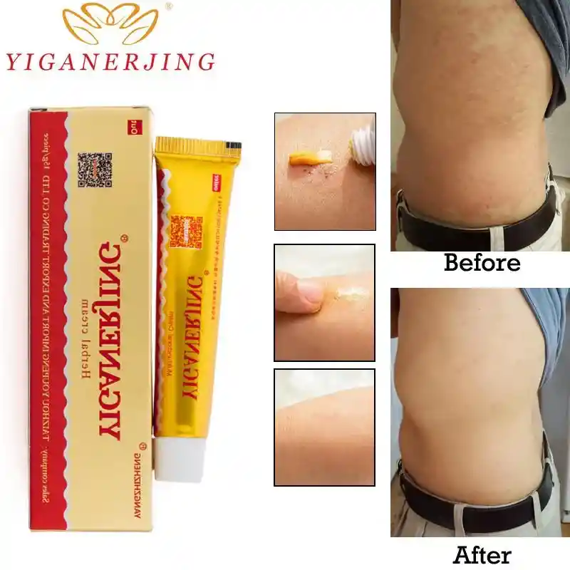 Crema China Yiganerjing Ezcema Psoriasis Piquiña Rasquiña Carranchin