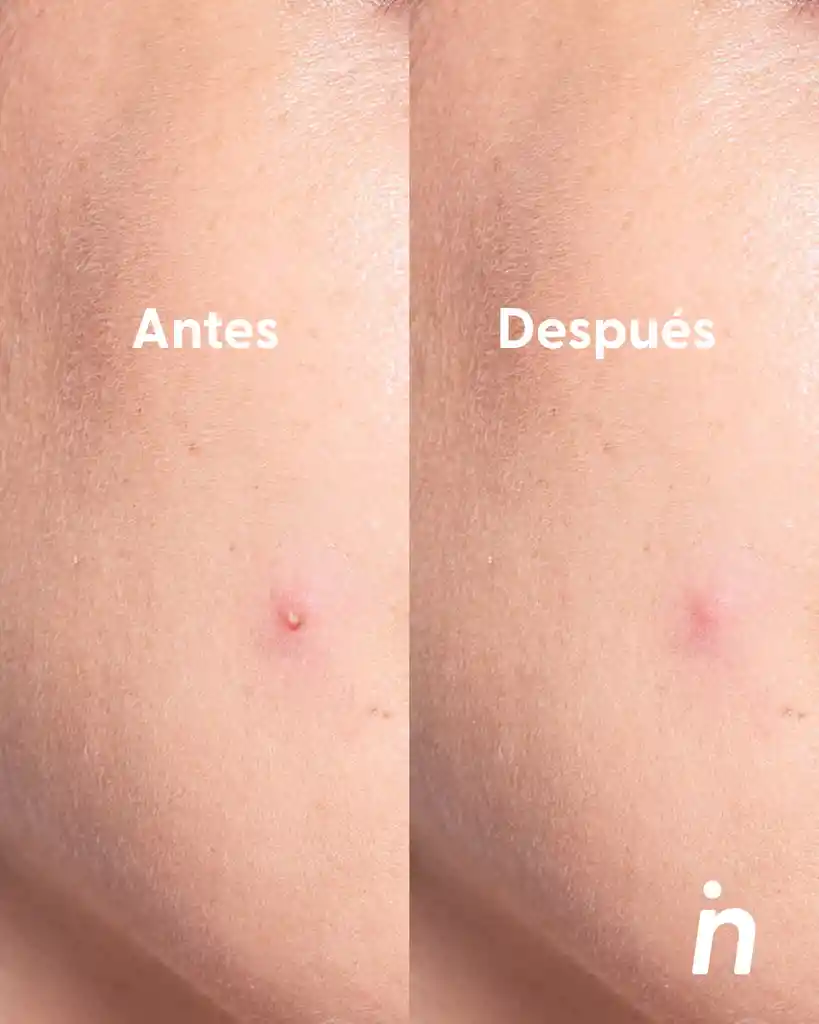 Parches Hidrocoloides Para Acné - Nipskin