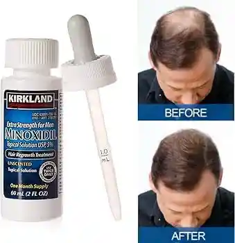 Minoxidil Kirkland