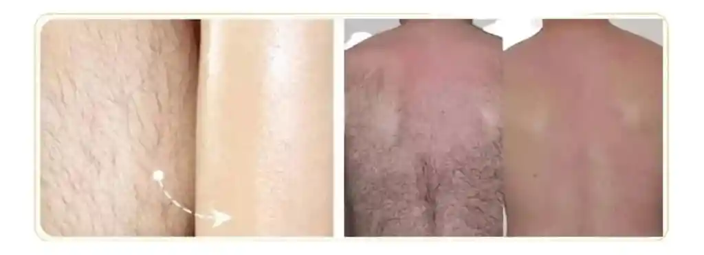 Depiladora Sin Dolor Cristal, Depiladora Fácil De Usar Reutilizable