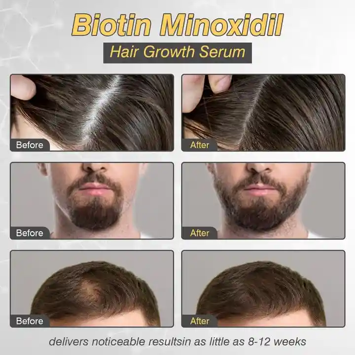 Suero De Minoxidil 5% Para Crecimiento Del Cabello | Unisex, Fortalece Folículos, Previene La Caída
