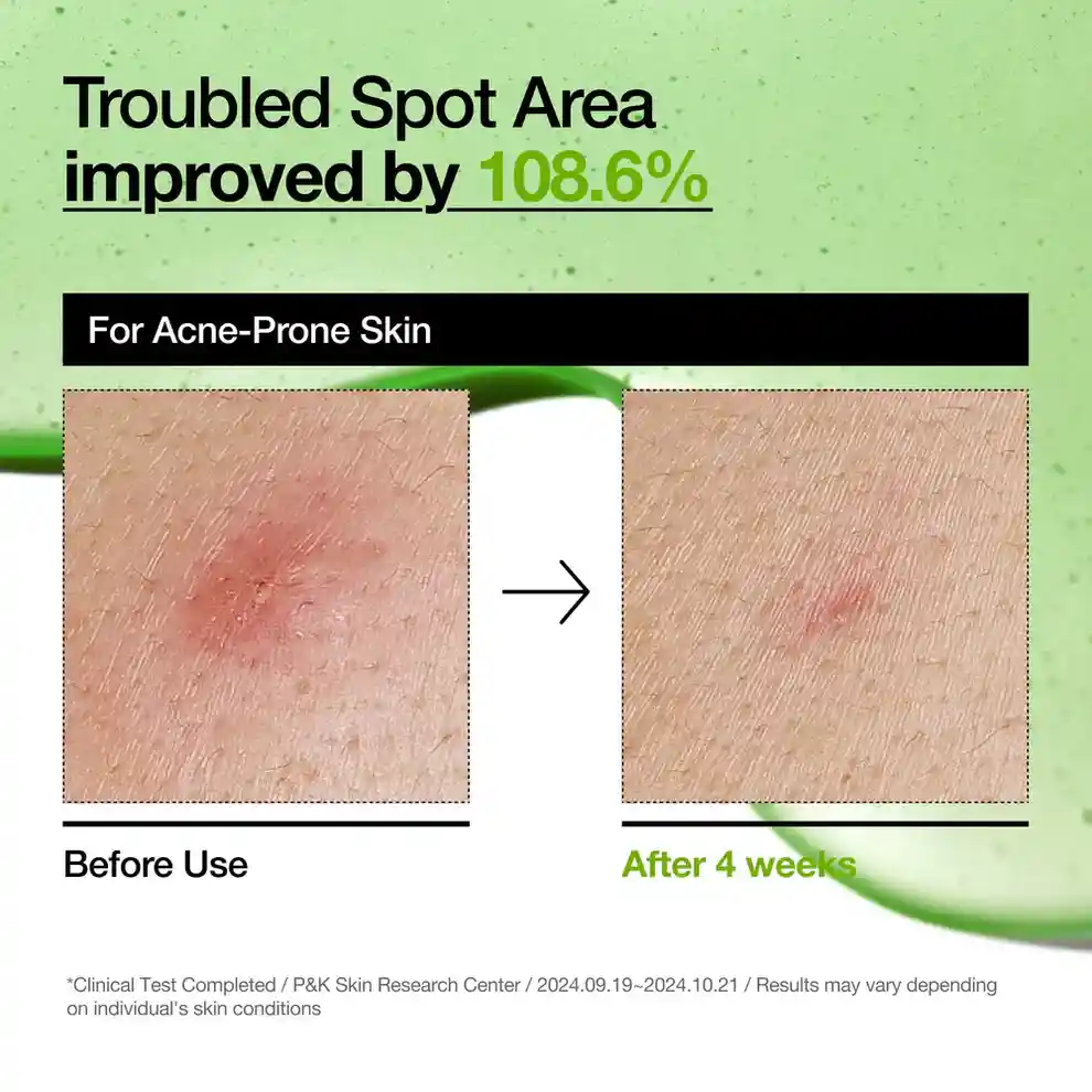 Sérum Anti-rojeces Con Ácido Azelaico 10% Y Ácido Hialurónico Anua Azelaic Acid 10 Hyaluron Redness Soothing Serum