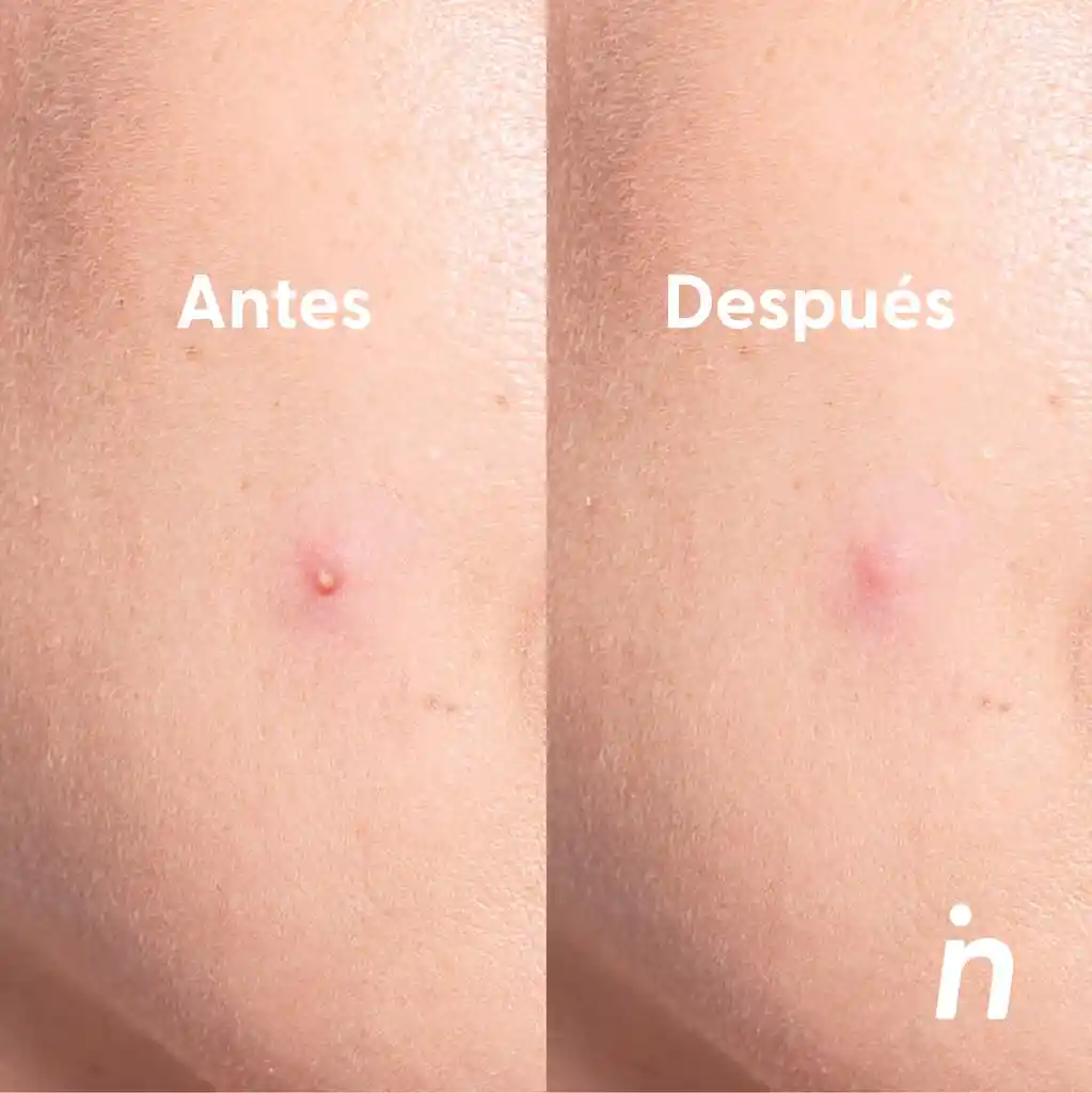 Parches Invisibles Para Acné X2 - Nipskin