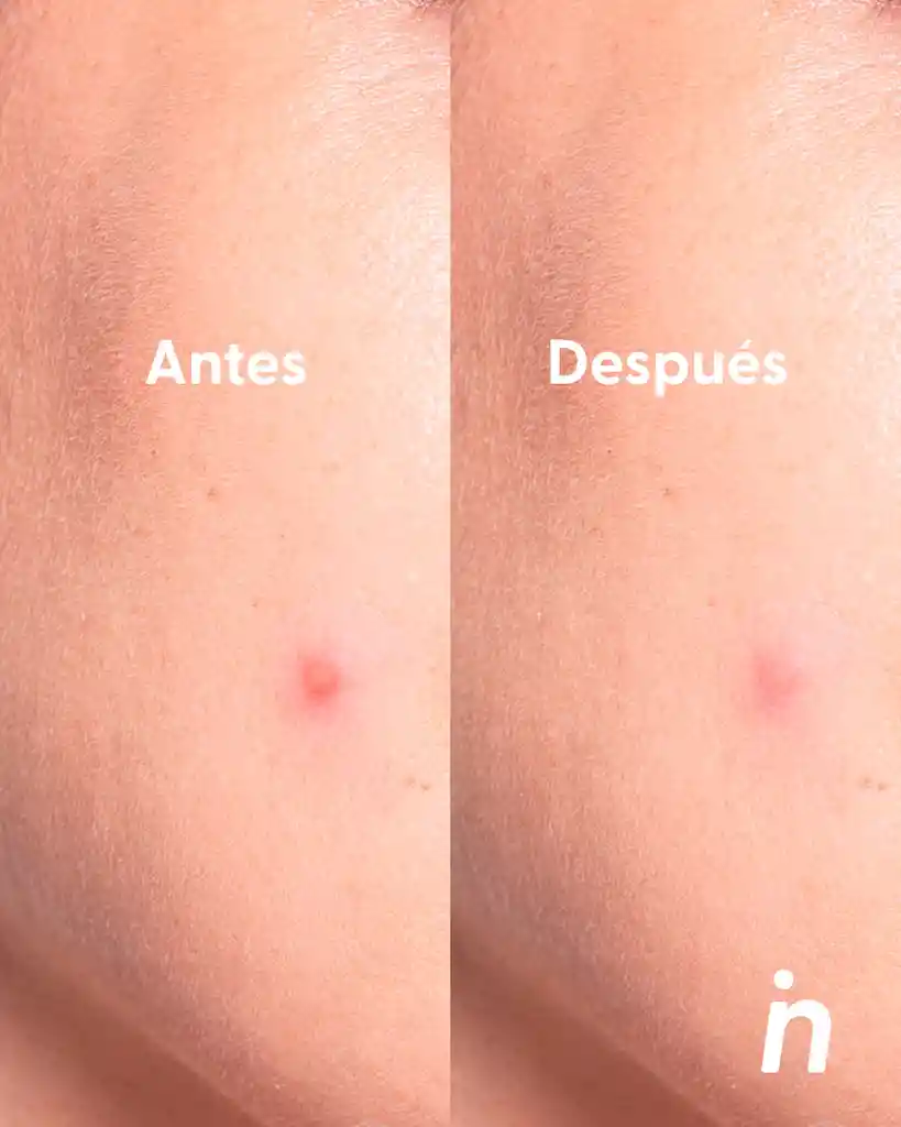 Parches Con Micro Cápsulas Para Granos X2- Nipskin